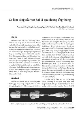 Ca lâm sàng sửa van hai lá qua đường ống thông