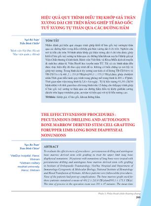 Hiệu quả quy trình điều trị khớp giả thân xương dài chi trên bằng ghép tế bào gốc tuỷ xương tự thân qua các đường hầm